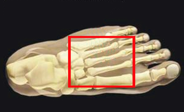 Маршевый перелом плюсневой кости 1 Маршевый перелом