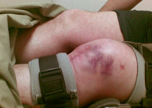 В чём опасность переломов коленной чашечки и как происходит лечение подобных травм 2 Симптомы перелома надколенника