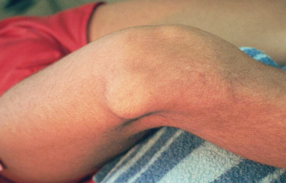 В чём опасность переломов коленной чашечки и как происходит лечение подобных травм 3 Перелом надколенника со смещением