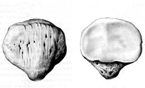 В чём опасность переломов коленной чашечки и как происходит лечение подобных травм 1 Перелом надколенника