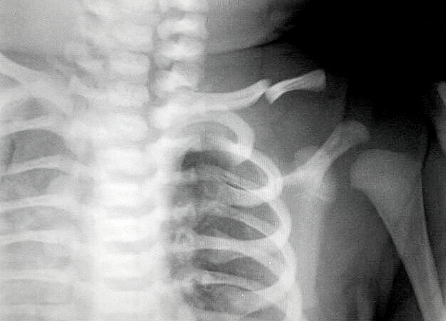 Важно: родителям о переломе ключицы у новорожденных 3 neonatal clavicle fracture