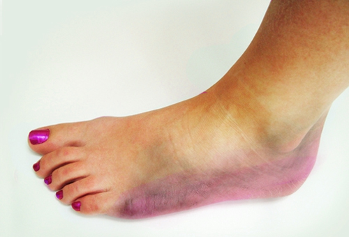 Симптомы самых распространенных переломов 6 Симптомы перелома ноги