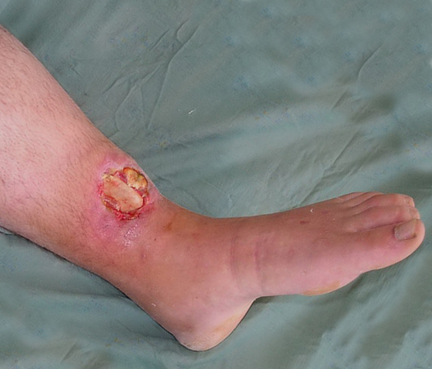 Открытые переломы. Первая помощь при открытых переломах 3 открытый перелом ноги