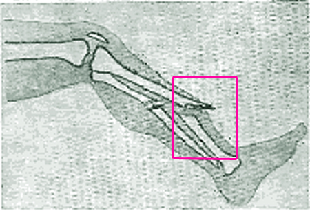 Открытые переломы. Первая помощь при открытых переломах 2 открытый перелом