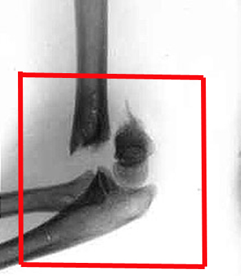 Перелом плеча и плечевой кости - лечение и реабилитация 3 Открытый перелом плеча