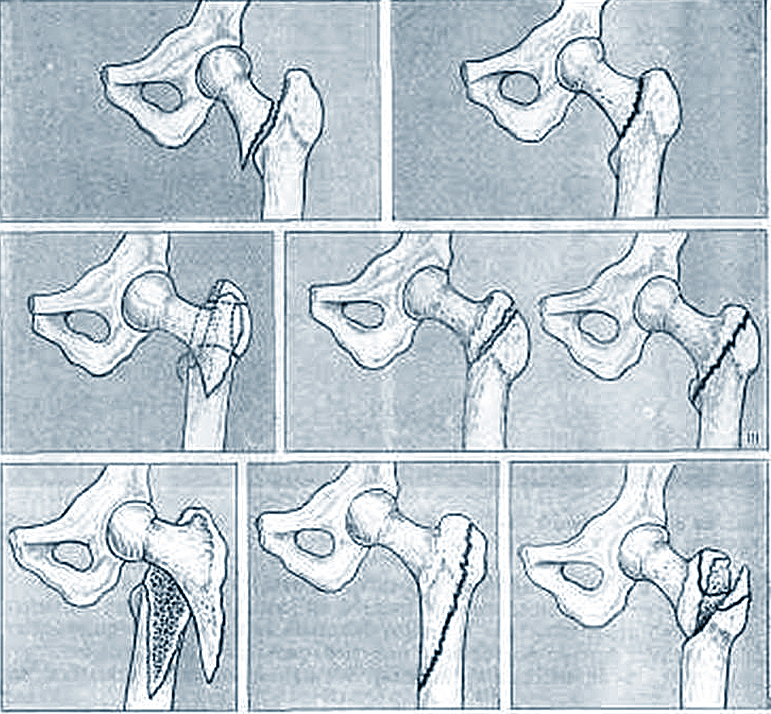Перелом шейки бедра 3 перелом бедра у пожилых людей