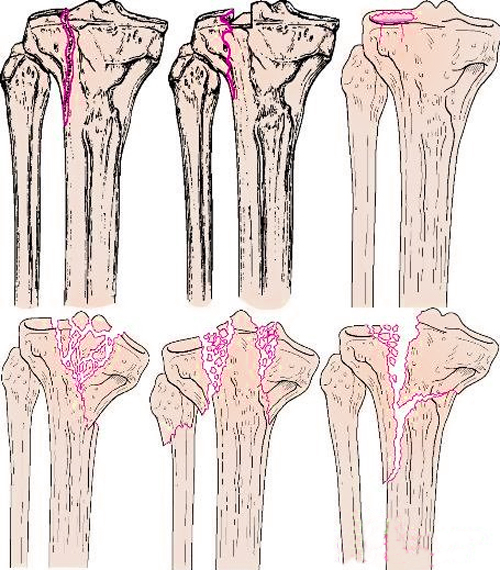 Перелом берцовой кости - разница в лечении у нас и за рубежом 1 перелом берцовой кости
