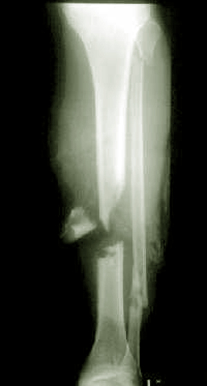 Перелом берцовой кости - разница в лечении у нас и за рубежом 2 перелом большой берцовой кости