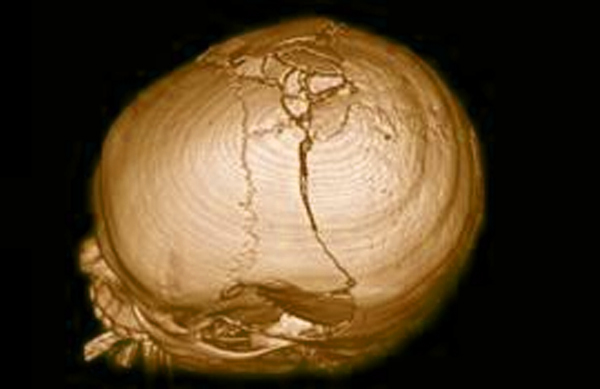 Перелом черепа - последствия и симптомы 1 перелом черепа
