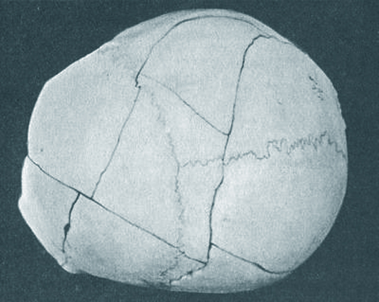 Перелом черепа - последствия и симптомы 5 перелом свода черепа