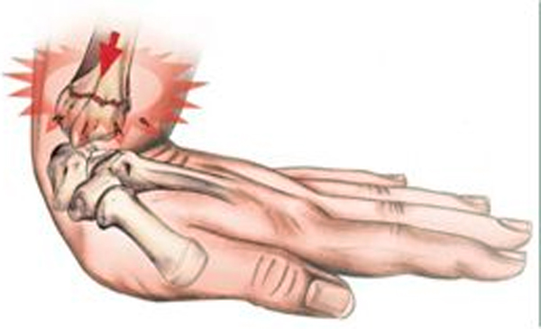 Перелом руки - симптоматика и лфк при реабилитации 2 перелом руки со смещением