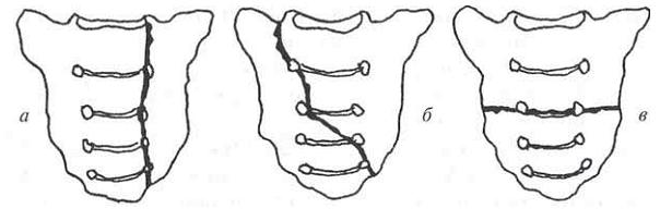 Виды переломов крестца Виды переломов крестца