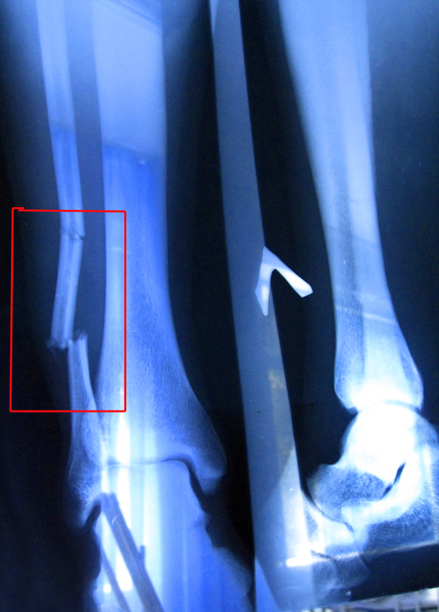 Перелом берцовой кости - разница в лечении у нас и за рубежом 4 перелом малой берцовой кости