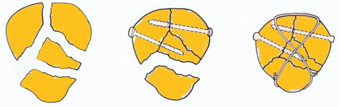 Как скрепляют множественный перелом Как скрепляют множественный перелом