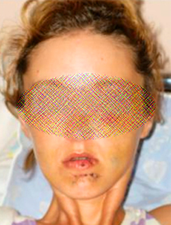 Перелом челюсти - симптомы и последствия 3 Последствия перелома нижней челюсти