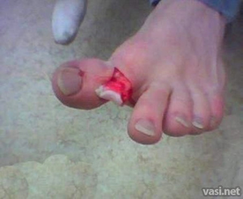 Перелом пальца на ноге - признаки и методы лечения 1 открытый перелом пальца на ноге