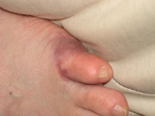 Перелом пальца на ноге - признаки и методы лечения 4 перелом мизинца на ноге