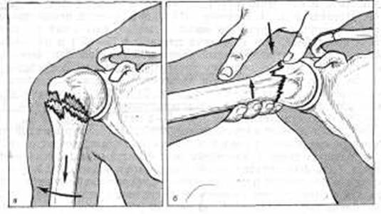 Перелом плеча в проксимальном отделе Перелом плеча в проксимальном отделе