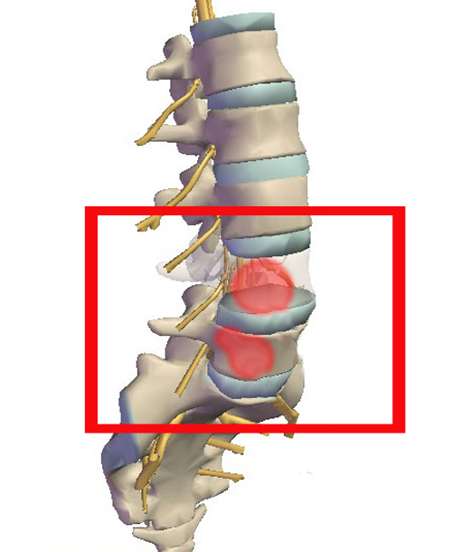 Перелом позвоночника - компрессионный перелом и его лечение 1 перелом позвоночника