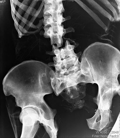 Перелом позвоночника - компрессионный перелом и его лечение 2 лечение перелома позвоночника