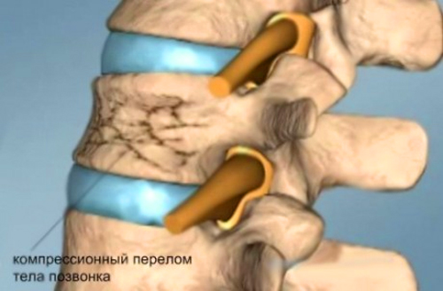 Перелом позвоночника - компрессионный перелом и его лечение 3 компрессионный перелом позвоночника