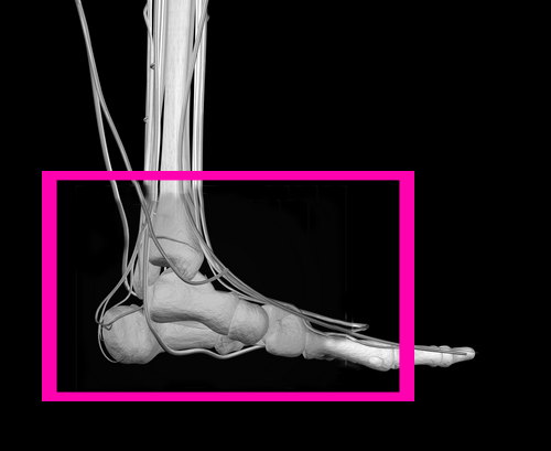 перелом пятки