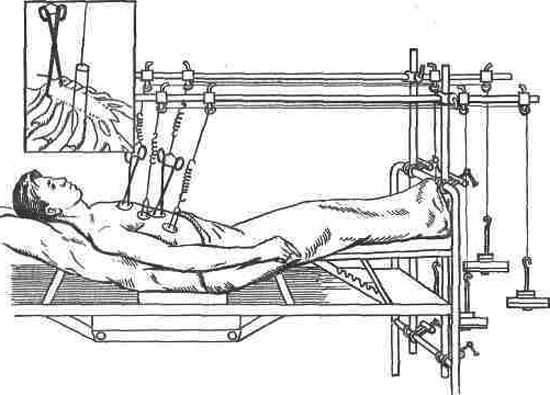 Перелом ребра - симптомы, реабилитация и лечение 3 лечение переломов рёбер