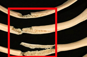 Перелом ребра - симптомы, реабилитация и лечение 2 признаки перелома ребра