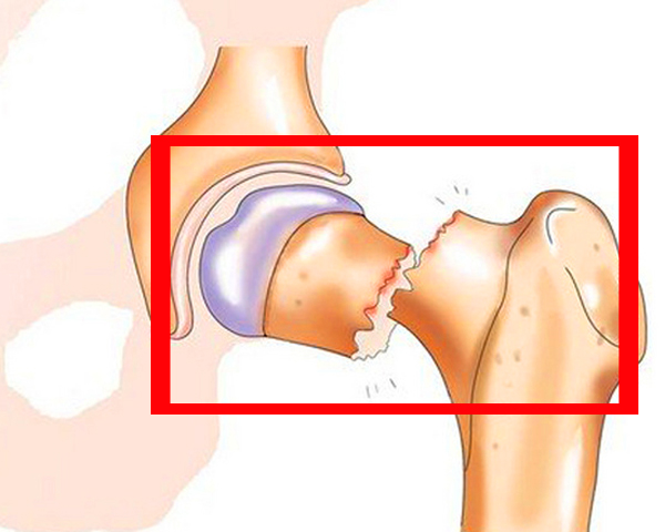 Перелом шейки бедра 2 perelom-sheiki-bedra-so-smesheniem