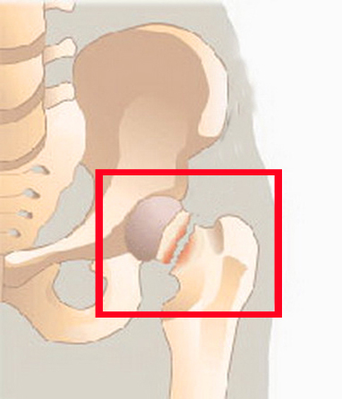 Перелом шейки бедра 1 перелом шейки бедра