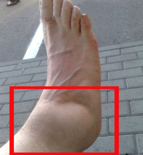 Перелом стопы 2 перелом стопы со смещением