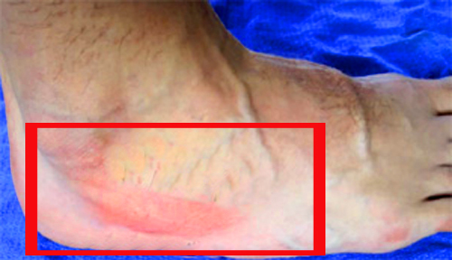 Перелом стопы 1 перелом стопы