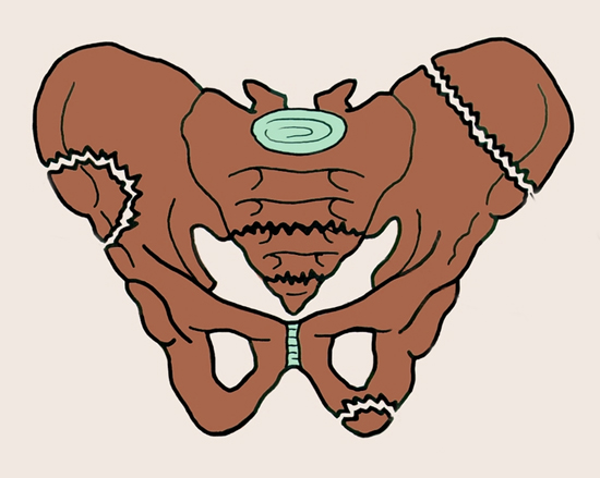 Реабилитация при переломе таза и возможные последствия 1 перелом таза