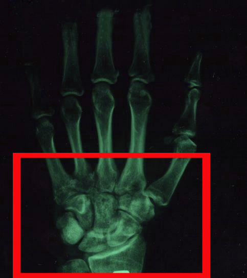 Симптомы перелома запястья, а так же его леччение и ЛФК 1 перелом запястья