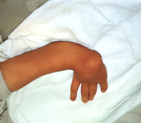 Симптомы перелома запястья, а так же его леччение и ЛФК 2 перелом запястья со смещением