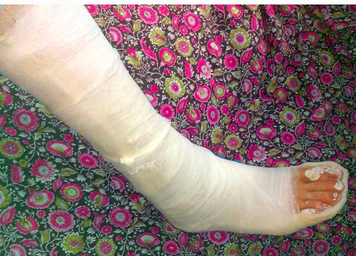 Причины и последствия переломов нижних конечностей 2 гипс при переломе ноги