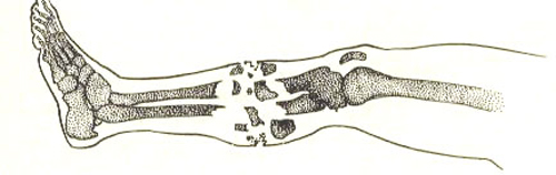 Причины и последствия переломов нижних конечностей 4 признаки перелома ноги