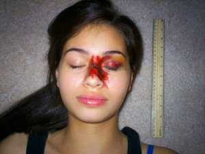 Перелом носа – симптомы, лечение и последствия 1 перелом носа