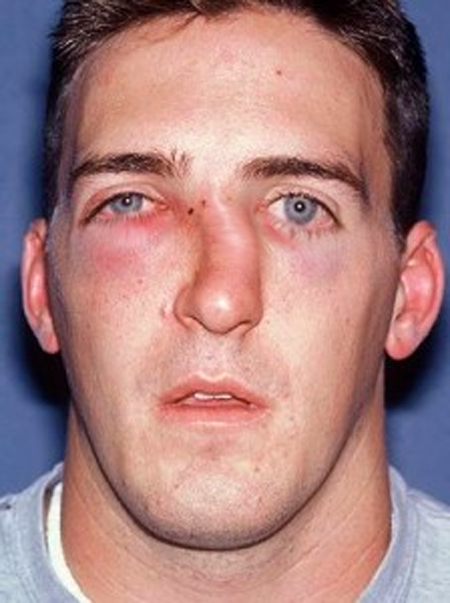 Симптомы самых распространенных переломов 9 последствия при переломе носа