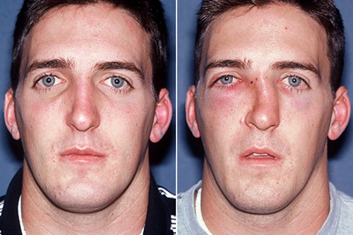 Перелом носа – симптомы, лечение и последствия 2 как меняется лицо при переломе носа