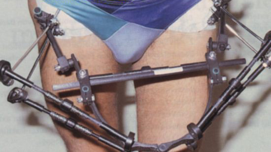 Лечение при переломе крестца Лечение при переломе крестца