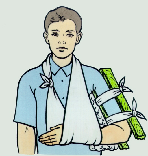 Перелом плеча и плечевой кости - лечение и реабилитация 4 лечение перелома плечевой кости