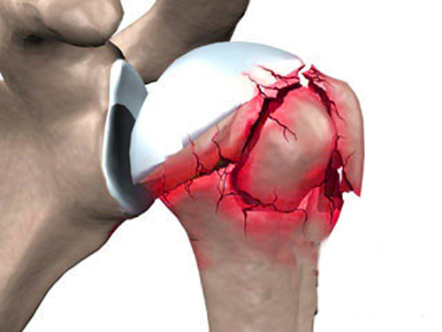 Перелом плечевого сустава и его лечение 2 Причины перелома сустава плеча