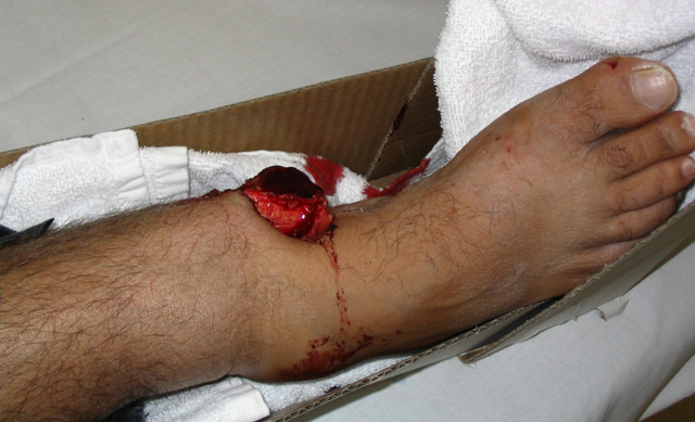 Костная мозоль - тонкие грани между нормой и патологией 2 Полный перелом кости