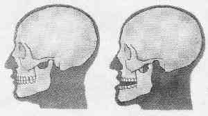 Как возникают вывихи челюсти Как возникают вывихи челюсти
