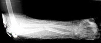 Симптомы самых распространенных переломов 3 симптомы перелома руки