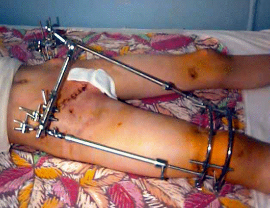 Перелом тазобедренного сустава и его лечение 4 Последствия переломов тазобедренного сустава