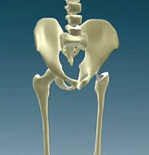 Перелом тазобедренного сустава и его лечение 3 Симптомы перелома тазобедренного сустава