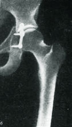 Перелом тазобедренного сустава и его лечение 2 Перелом вертлужной впадины