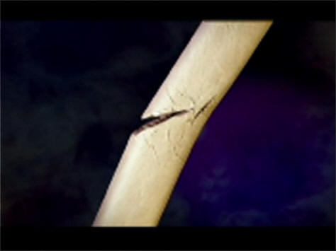 Трещина в кости Трещина в кости